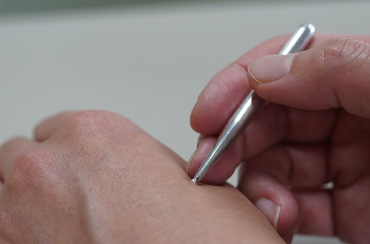 Acumiho Moxibustion - Tenkyu Procedure Acumiho Moxibustion - Tenkyu Procedure
