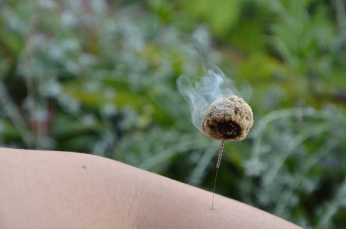 Acumiho Moxibustion - Kyuto Shin Procedure Acumiho Moxibustion - Kyuto Shin Procedure