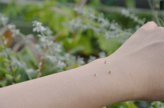 Acumiho Moxibustion - Tenkyu Procedure