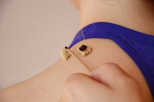 Acumiho Moxibustion - Tenkyu Procedure Acumiho Moxibustion - Tenkyu Procedure
